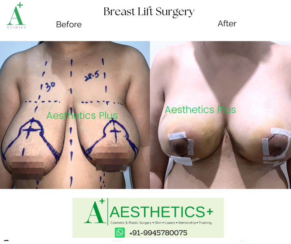 Breast Lift Surgery in Bloomington, IL, Mastopexy