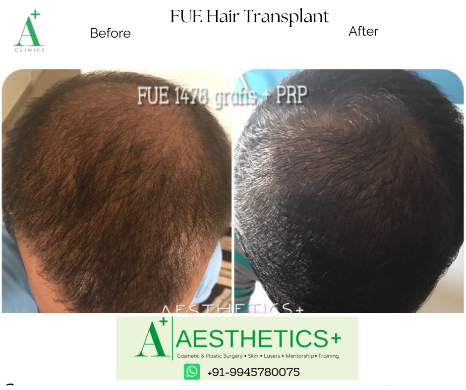 FUE Hair Transplant in Bangalore - Aesthetic Plus | Cosmetic surgeries,  Liposuction, Dermal Fillers, Breast Enhancement