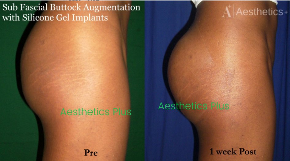 Buttock Augmentation Surgery in Bangalore